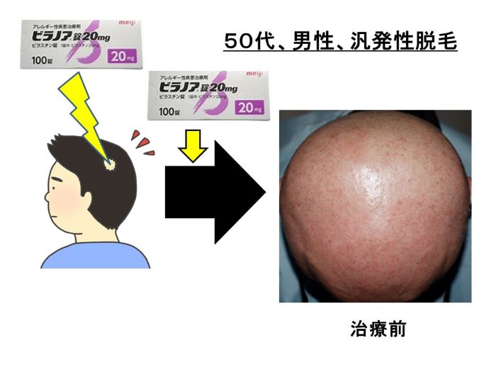 円形脱毛症　病院